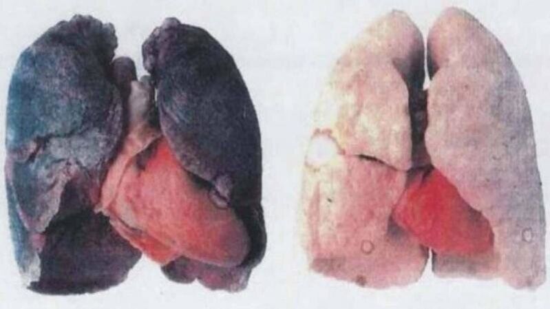 Mnogi kronični alkoholičari umiru zbog oštećenja pluća (lijevo)