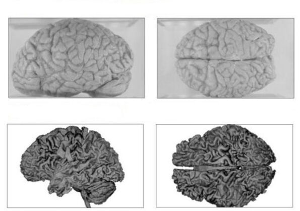 Mozak zdrave osobe (gore) i mozak alkoholičara s nepovratnim posljedicama (dolje)